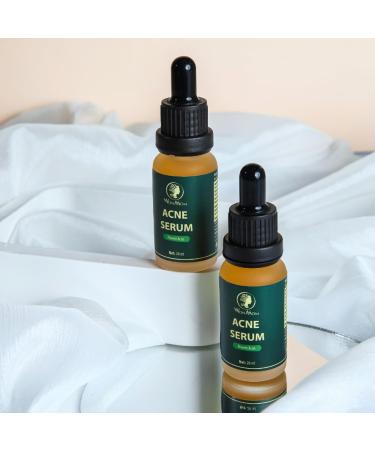 Buy Acne Serum (0.7 fl oz) | Fast International Shipping & Clear Skin Solution - Buy Online on GoSupps.com