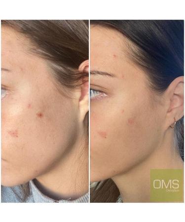 Oh My Skin: Exfoliating Smoothing Brightening & Hydrating Clinical Home Therapy Gel Cream. Enzyme Technology perfect for Pore Refinement Fine Lines Acne Blemishes & sensitive skin. Made in UK - Buy Online on GoSupps.com