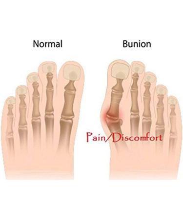 Unisex Hallux Valgus Correction - Foot Pain Relief Big Toe Cyst Treatment (2pcs) | International Shipping Available - Buy Online on GoSupps.com