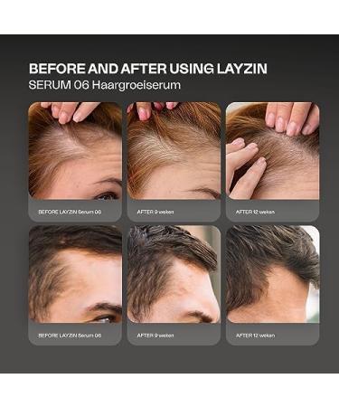  Layzin Serum 06 Hair Loss and Thinning | Promotes Hair Growth for Men and Women | Beard Growth for Men | Anti-Hair Loss Including - Buy Online on GoSupps.com
