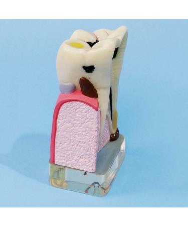 Dytah Dental Implant Model - Tooth Pathology & Crown Bridge Demonstration | Parodontal Sortal Teeth & Gums Educative Model for Dental Care - Buy Online on GoSupps.com