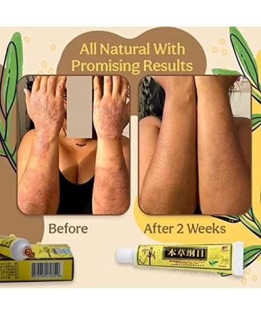 Cr me de gu rison aux herbes bio contre l'ecz ma cr me aux herbes chinoises naturelles cr me pour le visage cr me pour le corps cr me anti-d mangeaisons usage externe (12pcs) - Buy Online on GoSupps.com