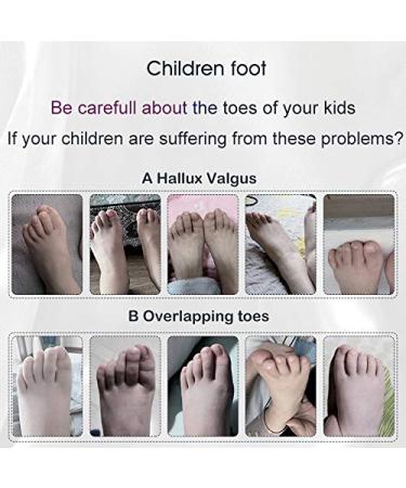 Bunion Relief for Kids - Gel Toe Separators with Loops for Overlapping Toes & Bunion Corrector Pads - Buy Online on GoSupps.com