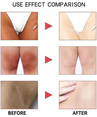 Kwiphiny Snow Bleach Cream Snow Bleach Cream for Private Part Intimate Areas Underarm Neck Knees Elbows Dark Skin Lightening Cream Dark Spot Remover Cream Skin Lightening Bleaching Cream 3PCS - Buy Online on GoSupps.com