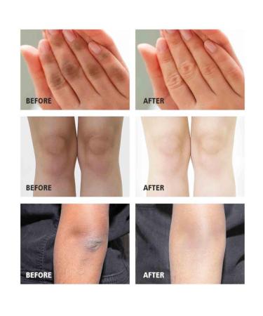 Peach Whitening Cream for Dark Knees Elbows & Knuckles - Strong Brightening & Spot Correction - International Shipping Available - Buy Online on GoSupps.com