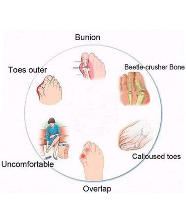 Men's Orthopedic Bunion Corrector Sandals with Arch Support - Black, Size 6.5 - Buy Online on GoSupps.com