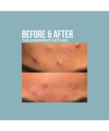 Absorbzit Overnight Night Time Patches - 36 Patches - Vegan & Cruelty Free - Buy Online on GoSupps.com