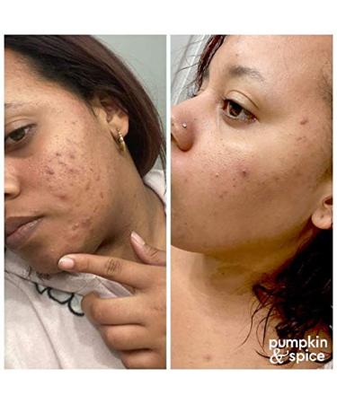 Pumpkin Spice Clay Enzyme Facial Mask - 3.5 oz | Pore Minimizer, Acne Treatment, Anti-Aging, Hydrating | Organic Pumpkin Seed Oil - Buy Online on GoSupps.com