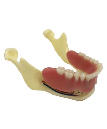 Zapion dental implant model tooth lower jaw teeth study model anatomically bone-lower jaw model overdenture inferior teaching study teaeth model