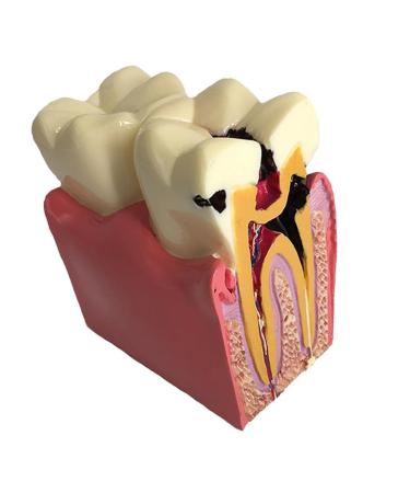 Colcolo Teeth Model 6 Times Caries Compare Examination Models Study And Research