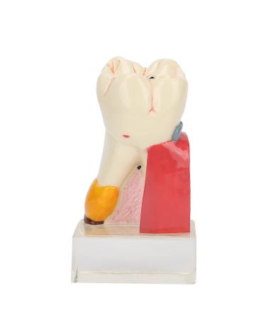 Verdant Touch Tooth Model for Dentists 6x Caries Tooth Models for Dentist Study Teaching Demonstration