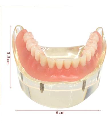 Dental Model Overdenture with 4 Implants - Ideal for Teaching Toothbrushing & Hygiene in Classes - International Shipping Available - Buy Online on GoSupps.com