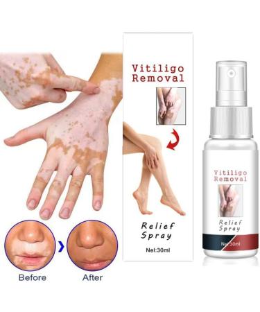 Vitiligo Removal Relief Spray - Reduces White Spots on Skin - 3pcs - Buy Online on GoSupps.com