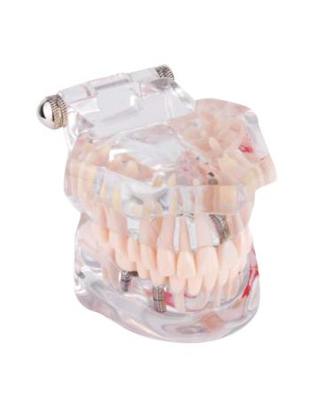 Cocoarm Removable Tooth Model - Dental Care Demo Tool for Teaching Study & Implant Education - Buy Online on GoSupps.com