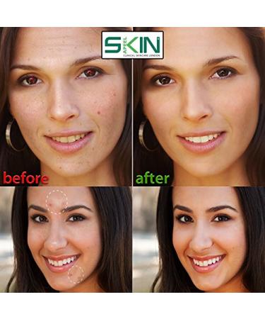 Skinapeel Premium Blackhead & Blemish Remover Kit - 5 Dermatologist-Approved Stainless Steel Tools for Acne Treatment - Travel Case with Mirror - Cure Pimples & Facial Impurities - Buy Online on GoSupps.com