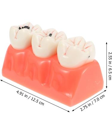 Ultechnovo Dental Recovery Tool Set - 2 Caries Tooth Models for Teaching & Demonstration | 12.5x7x6.5cm - Ideal for Dentistry Education - Buy Online on GoSupps.com