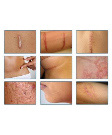 Silicone Scar Sheets | Medical Grade Clear Gel Strips for Surgical Scars | C-Section, Breast, Burn, Keloid, Acne | 6cm x 15cm | Scar Tape for Effective Scar Removal - Buy Online on GoSupps.com