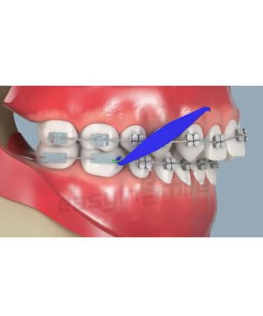 Disposable Dental Elastic Rubber Band Placers for Braces - 10PCS - Buy Online on GoSupps.com