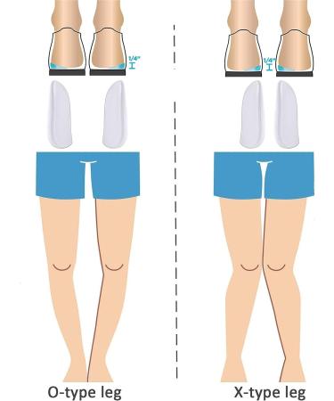Olukssck 2 Pairs Medial Lateral Heel Wedge Inserts - Orthopedic Supination Pronation Insoles for Knock Knee Pain, Osteoarthritis, O/X Type Leg Corrective - Buy Online on GoSupps.com