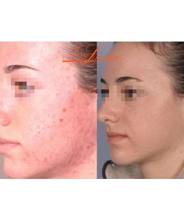 30% Salicylic Acid Peel Kit - BHA Face Peeling Treatment (1.69oz) | Chemical Peel for Glowing Skin - Buy Online on GoSupps.com