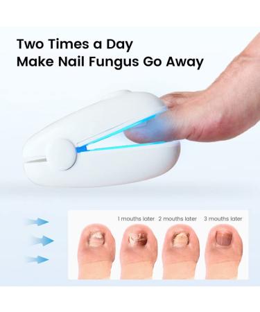 Toenail Fungus Laser Treatment Device - Effective Nail Fungal Cleaner for Onychomycosis on Fingernail & Toenail - Toe Fungus Nail Treatment - Buy Online on GoSupps.com