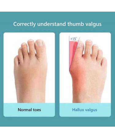 Keenso 2pcs Bunion Corrector & Toe Separators for Women - Universal Female Toe Splints for Overlapping Big Toe - Buy Online on GoSupps.com