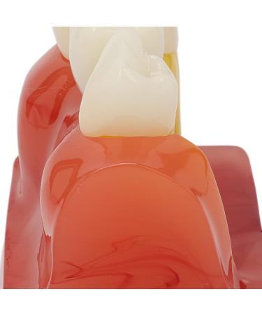 Verdant Touch Crown Bridge Demonstration Model - 4X Dental Implant Model for Doctor-Patient Education | International Shipping - Buy Online on GoSupps.com