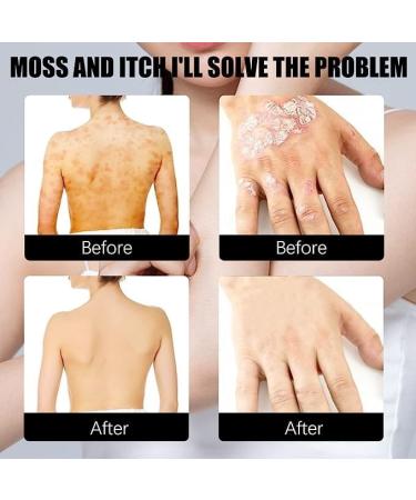 BIVOO Herbal Psoriasis Relief Spray - Stops Burning and Itching, Moisturizes Skin - 2pcs - Buy Online on GoSupps.com