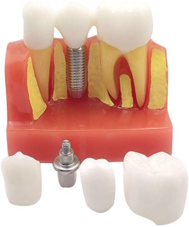 4x Dental Implant Teeth Model with Removable Crown - Crown & Bridge Dentist Training Tool for Patient Analysis | International Shipping - Buy Online on GoSupps.com