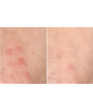 Nakery Intensive Repair Treatment Eczema Relief Soothing Wash for Face & Body | 2% Colloidal Oatmeal | Immediate Relief - Buy Online on GoSupps.com