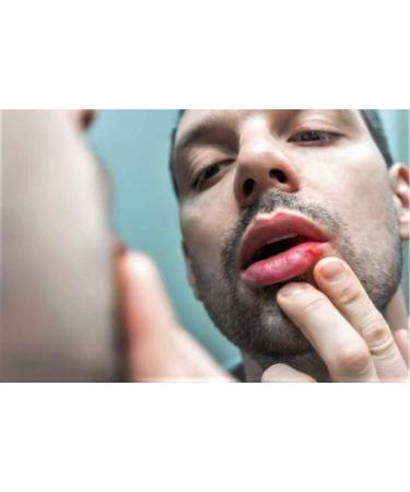 Cold Sore Lip Oil - Natural Herbal Treatment for Fast Relief - Vegan Formula - Buy Online on GoSupps.com