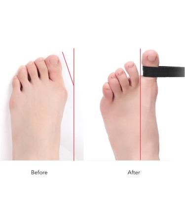 Bunion Toe Straightener | Corrector Strap for Overlapping Toes | Relieve Fatigue & Restore Alignment | Flexibility Training - Buy Online on GoSupps.com