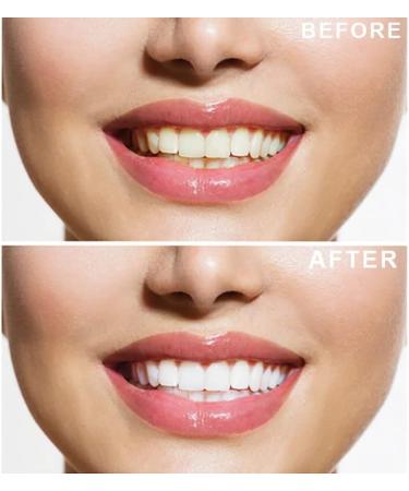 Professional Teeth Whitening Kit with 6X3ml Whitening Gels and LED Light - Safe, Easy, and Effective Home Teeth Whitening Solution - Buy Online on GoSupps.com