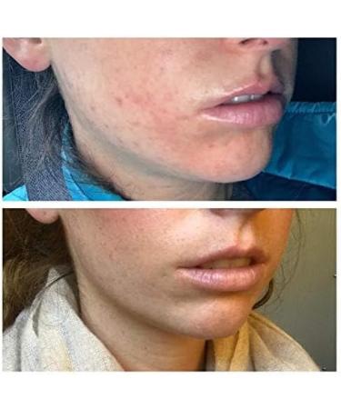 Avene Cicalfate Repair Cream Hypoallergenic for Sensitive & Irritated Skin 100 ml - Buy Online on GoSupps.com