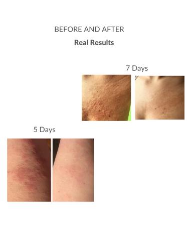 Recovery Cream - PH Balance Skincare Eczema Cream | Itchy Skin Relief for Burns Dermatitis Psoriasis | All-Natural Fragrance-Free Cruelty-Free Paraben-Free - 2oz - Buy Online on GoSupps.com