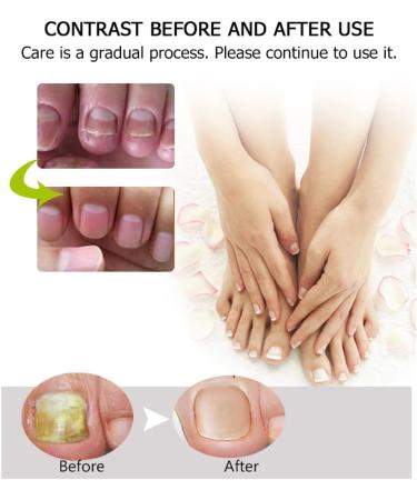 Nail Repair Treatment Gel - Instantly Renew Yellow, Cracked Nails - Buy Online on GoSupps.com
