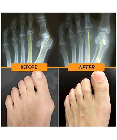 Buy Bunion Splint & Orthopedic Corrector | Adjustable Big Toe Straightener for Men & Women - International Shipping - Buy Online on GoSupps.com