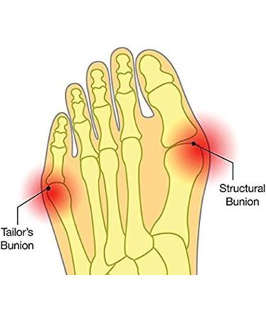 Hallux Valgus Bunion Corrector & Relief Cuff with Gel Pads - Small - International Shipping - Buy Online on GoSupps.com