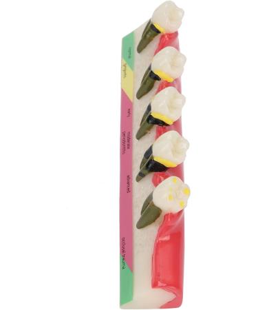 Shop Verdant Touch Tooth Model - Dental Periodontal Disease Study Tool for Schools | International Shipping Available - Buy Online on GoSupps.com