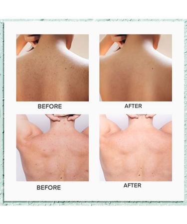 Tea Tree Oil Back Acne Treatment - 2% Salicylic Acid Body Solution for Teens - 4.05 Ounce - Buy Online on GoSupps.com