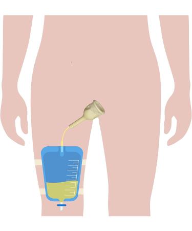 Urinary Catheter Kit - 5 Day External Self-Seal Condom Catheters + Leg Bag 750ml + Straps - XLarge 35mm (1.37 Inches) - 5.9 inch Tube - Buy Online on GoSupps.com