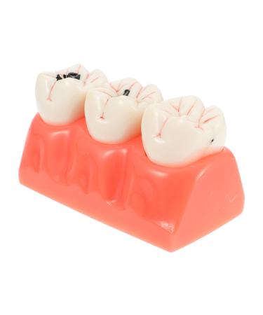 Ultechnovo Recovery tool Ser from 2 caries tooth teeth model study caries tooth teaching tools demonstration teeth model model disease teeth hotfix tool 12.5x7x6.5cmx2pcs such as shown