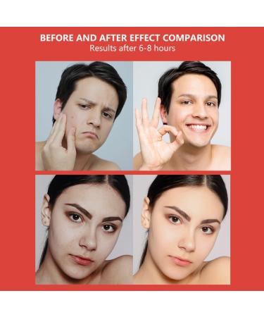 Buy Hydrocolloid Pimple Patches - Acne & Blemish Covers for Clear Skin | International Shipping Available - Buy Online on GoSupps.com