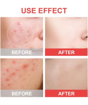 Buy Invisible Acne Patches - 144 Hydrocolloid Stickers for Face & Body | Effective Acne Treatment - International Shipping - Buy Online on GoSupps.com