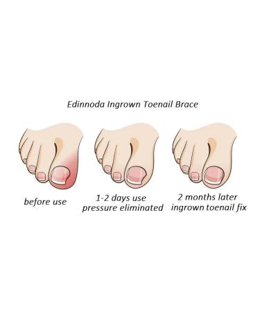 Ingrown Toenail Correction Kit | Pain-Free Home Treatment for Big Toe Nail (Upgraded Brace Patent Pending) - Shop Now - Buy Online on GoSupps.com