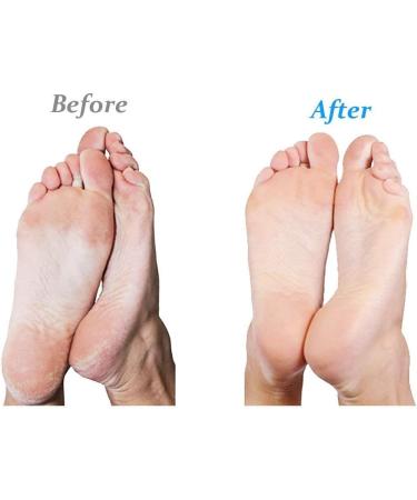 Buy Emjoi Micro-Pedi Callus Remover (Lilac) - Best Foot Care Solution for Smooth Feet - Fast International Shipping - Buy Online on GoSupps.com