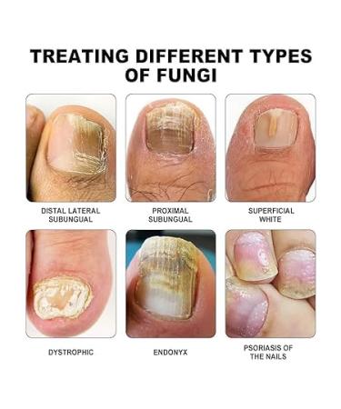 Furzero Purenail Laser Therapy Device | Effective Nail Fungus Treatment & Light Therapy for Healthy Nails - Buy Online on GoSupps.com