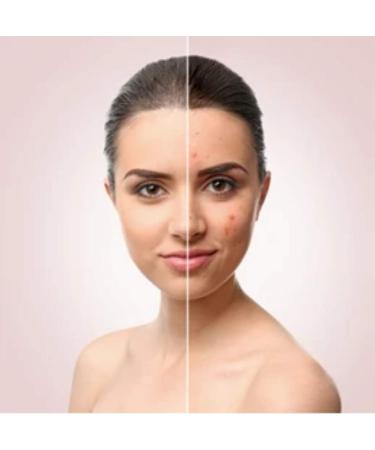 Sulphur Soap 10% Sulfur 200g Avena Sulphur Soap Rid Severe Acne Rosacea - Buy Online on GoSupps.com