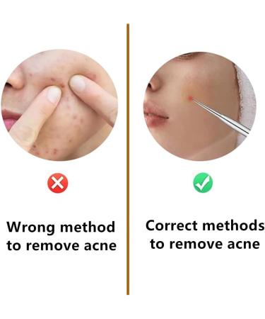 Blackhead Remover Tool 8 Pcs Pimple Popper Tool Kit Blackhead Extractor for Face Nose Comedone Zit Acne Whitehead Pores Blemish Fat Granules Stainless Steel Facial Skin Care Kit - Buy Online on GoSupps.com