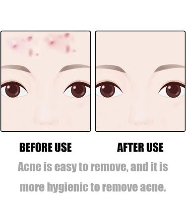 DMQUANLIAN Professional Comedones Extractors Stainless Steel Ingrown Hair Tweezers Blackhead Remover Splinter Sharp Tip Tweezers for Acne Blackhead tweezer ingrown Hair Treatment - Buy Online on GoSupps.com